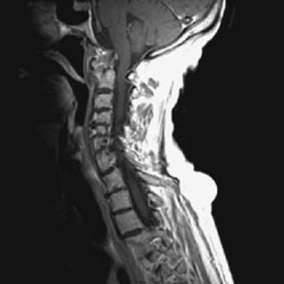 instability atlantoaxial figure 103h