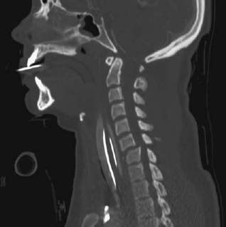 104 Teardrop Fracture | Radiology Key
