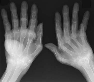 rheumatoid arthritis radiology findings)