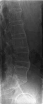 Ankylosing Spondylitis Radiology Key