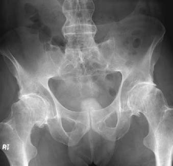 115 Ankylosing Spondylitis | Radiology Key