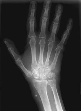 118 Amyloid Arthropathy Secondary to Renal Failure | Radiology Key
