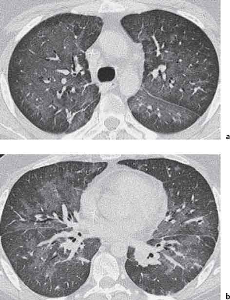 can lung cancer cause low oxygen levels