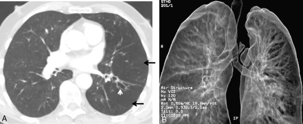 The Bronchi Radiology Key