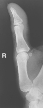 Upper Limb (Extremity) | Radiology Key