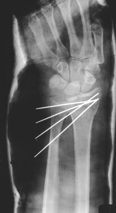 Osteochondroma-Related Pressure Erosions in Bony Rings Below the Waist