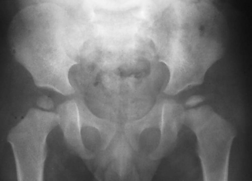 Hematologic Bone Diseases | Radiology Key