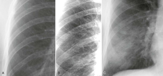 Introduction to Chest Radiography | Radiology Key