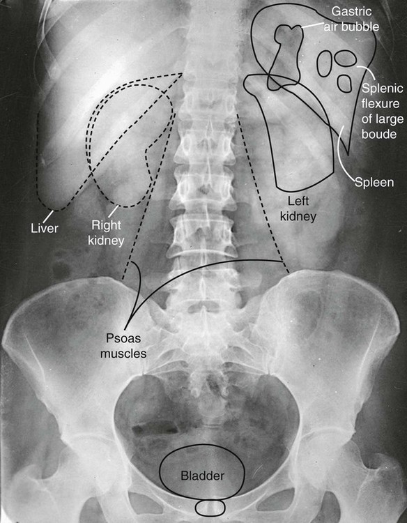 Introduction to Abdomen Radiography | Radiology Key