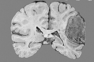 Pathology | Radiology Key