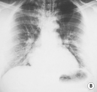 The Neonatal and Paediatric Chest | Radiology Key