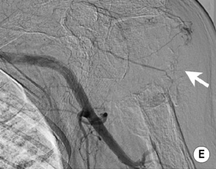 Interventional Vascular Radiology Techniques | Radiology Key