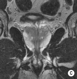 Prostate | Radiology Key