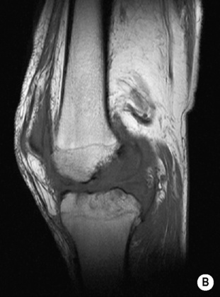 Bone and soft tissue infection | Radiology Key