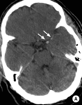 Cerebrovascular disease and non-traumatic haemorrhage | Radiology Key