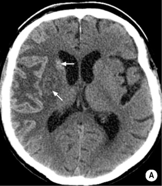 generate key map traumatic haemorrhage  disease  Radiology and Cerebrovascular Key non