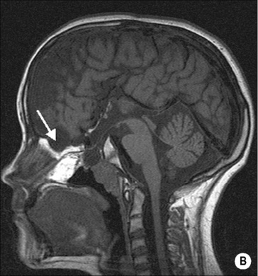 Paediatric neuroradiology | Radiology Key