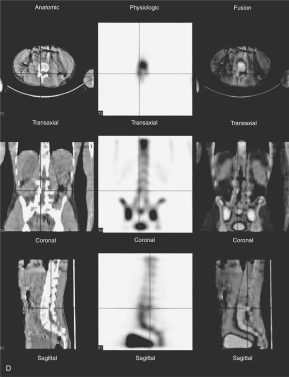 Nuclear Medicine—SPECT, PET, And Fusion Imaging | Radiology Key