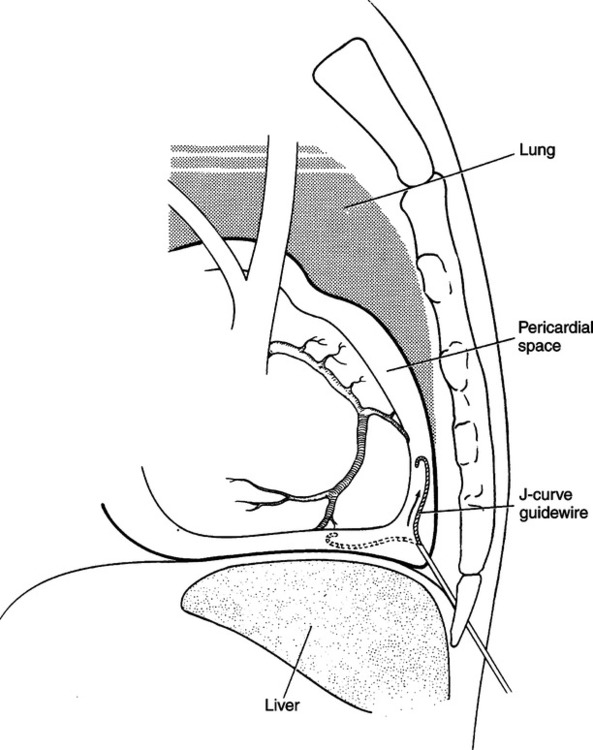 Cardiac Interventions | Radiology Key