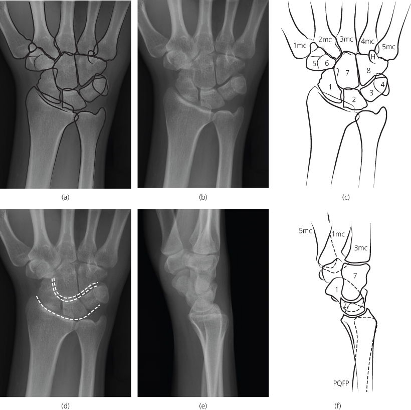 Visi Wrist Radiology Carpal Ligament Instability BVXX Visi Wrist Radiology Carpal Ligament Instability BVXX