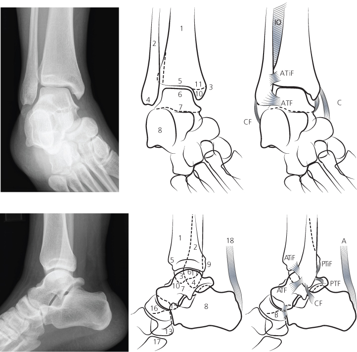 Extra-Caliber (carbon fiber) Radiolucent Tibia/Ankle System