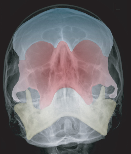 submentovertical zygomatic arches