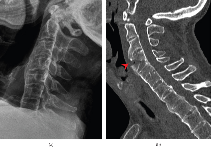 Cervical Spine | Radiology Key