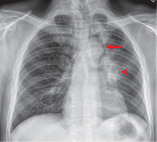 Chest | Radiology Key