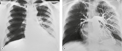 3. Basic Patterns In Lung Disease | Radiology Key