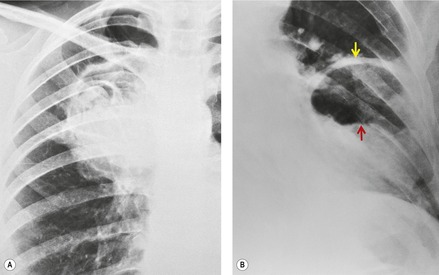 5. Infections Of The Lungs And Pleura 