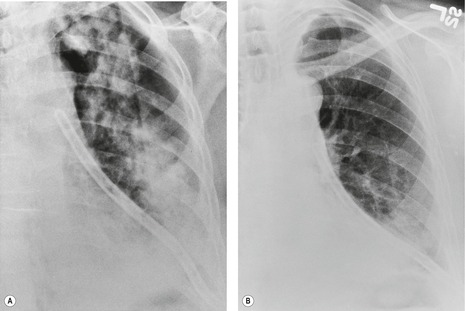 us/sclerosing-mediastinitis-causing-unilateral-pulmonary-edema-due-to ...