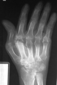 9. Arthritides | Radiology Key