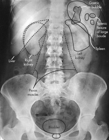 28 Introduction To Abdomen Radiography Radiology Key