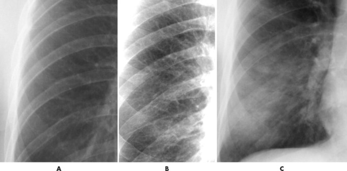 21. Introduction To Chest Radiography | Radiology Key