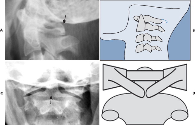 spina bifida occulta cervical spine