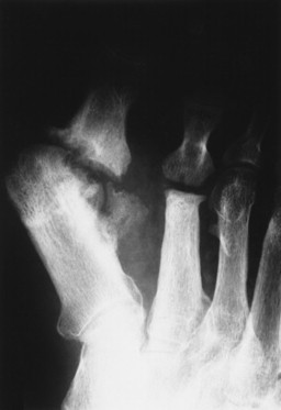 12. Infections | Radiology Key