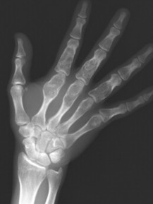 13. Bone Tumors and Related Diseases | Radiology Key