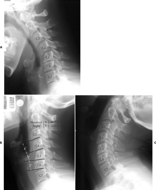 Cervical Spine Fusion C3-C5 ACDF, two views – Stock Trial Exhibits
