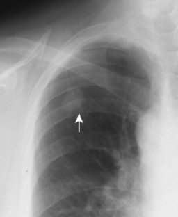 25. Thoracic Neoplasms | Radiology Key