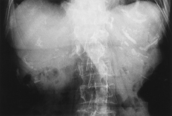 32. Abdomen Patterns | Radiology Key