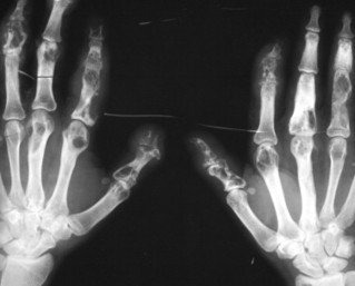 9. Arthritides | Radiology Key