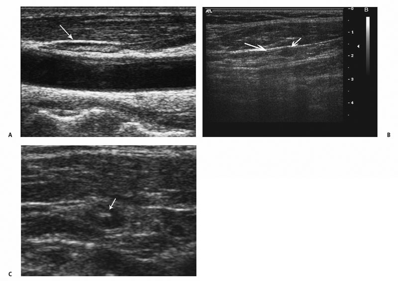 Superficial Lymph Node Biopsy | Radiology Key