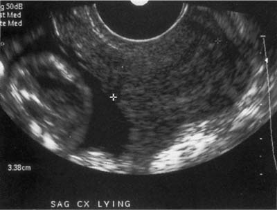 Premature Labor Radiology Key