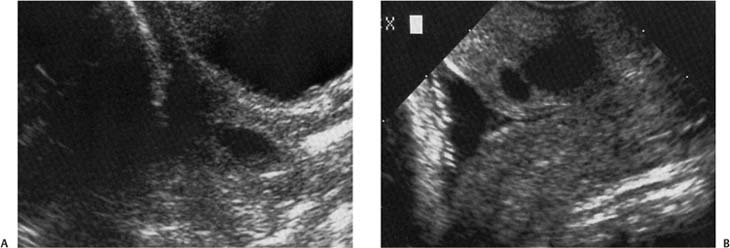 premature-labor-radiology-key