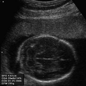 how accurate is gestational age by ultrasound