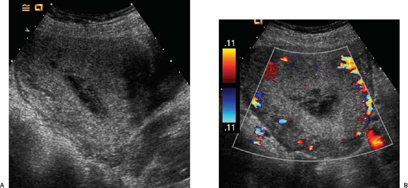 postpartum-complications-radiology-key