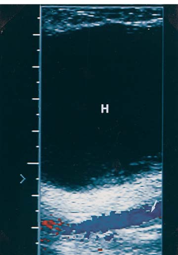 Groin Hematoma Ultrasound