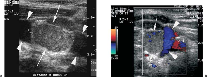 Arm Swelling | Radiology Key