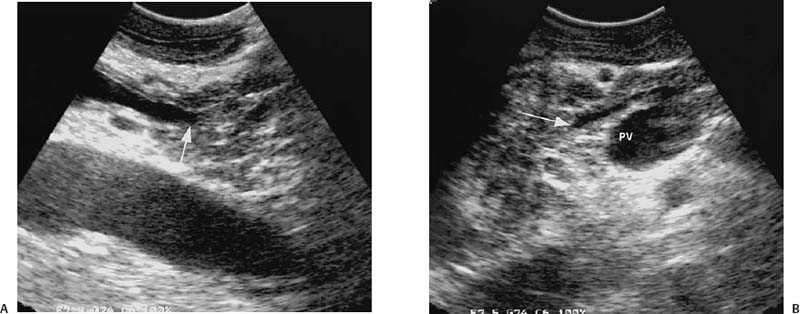 Intraoperative Ultrasound | Radiology Key