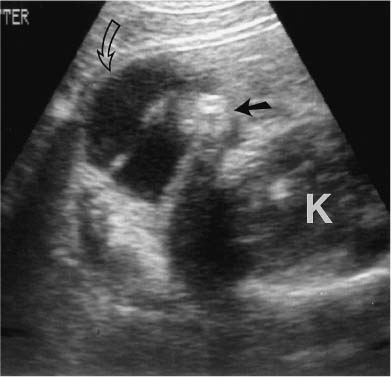 Acute Abdominal Trauma | Radiology Key